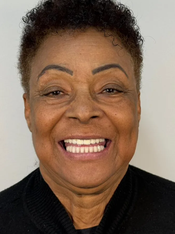 Paciente após a reabilitação com implante dentário na DentoEssence Santos