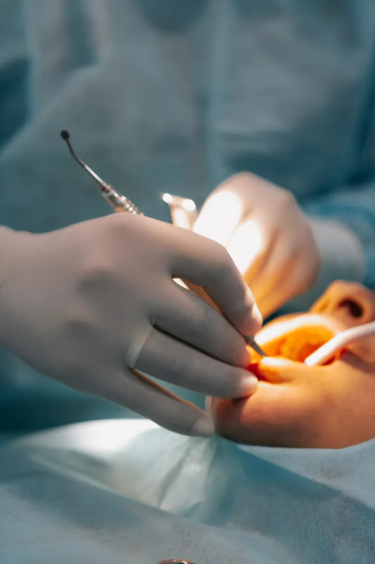 Detalhe de procedimento cirúrgico de implante dentário na DentoEssence Santos